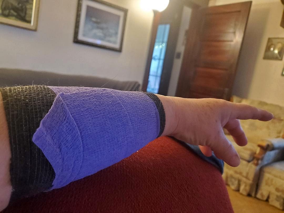 Bandage from burn, 04-22-24.jpg
