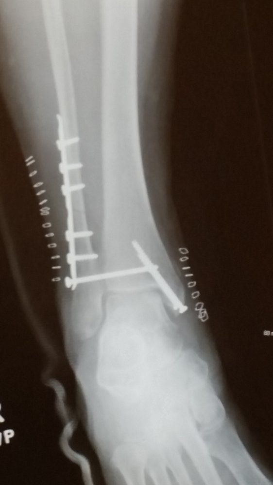 broken ankle.jpg